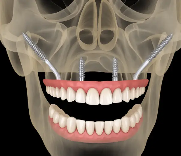 impianti zigomatici albania